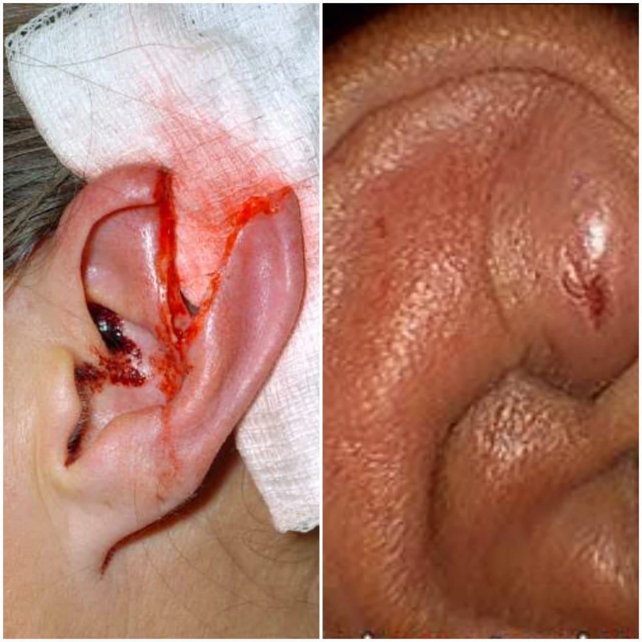 Ear Trauma lobuloplasty