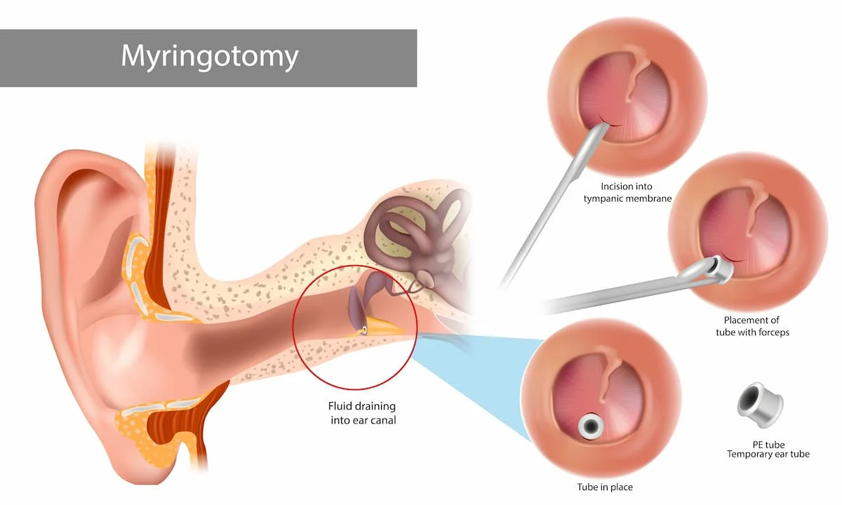 myringootomy surgery in bhubaneswar