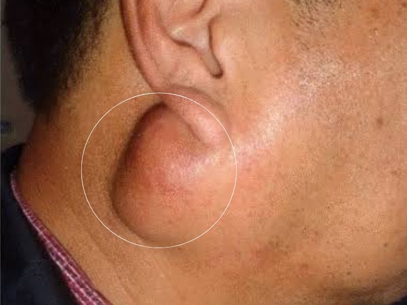 parotid gland surgery in bhubaneswar