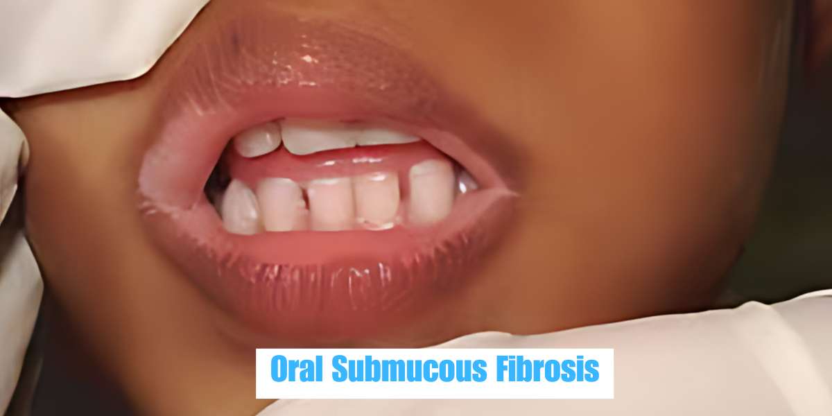 What is Oral Submucous Fibrosis?