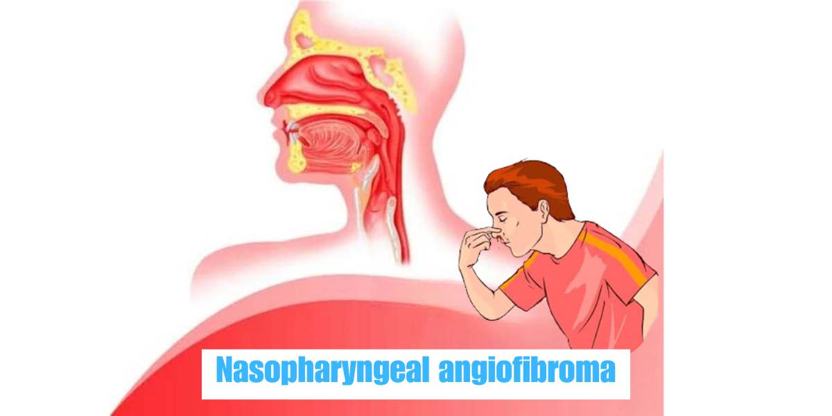 What is Nasopharyngeal Angiofibroma?