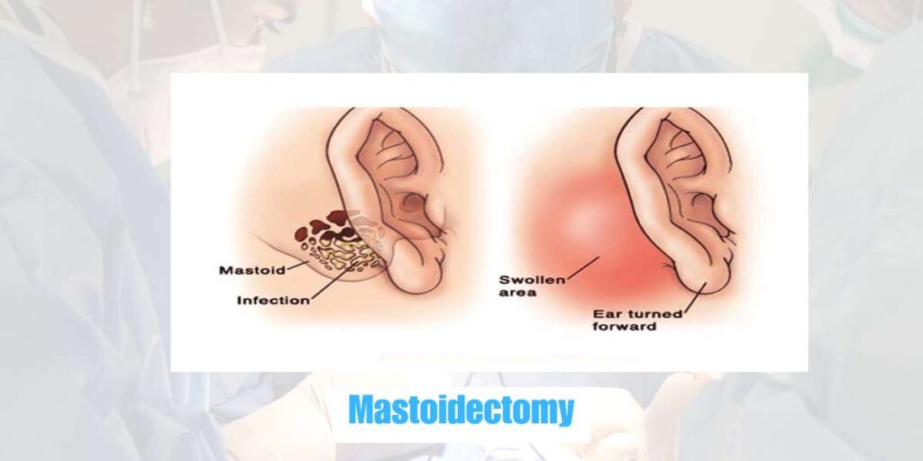 Mastoidectomy treatment in bhubaneswar