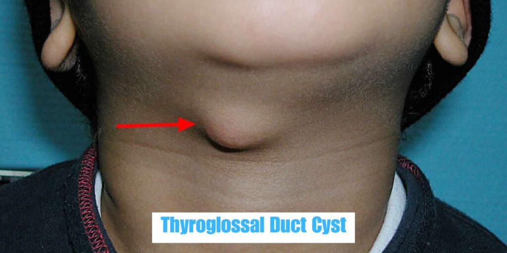 Thyroglossal duct cyst treatment in bhubaneswar