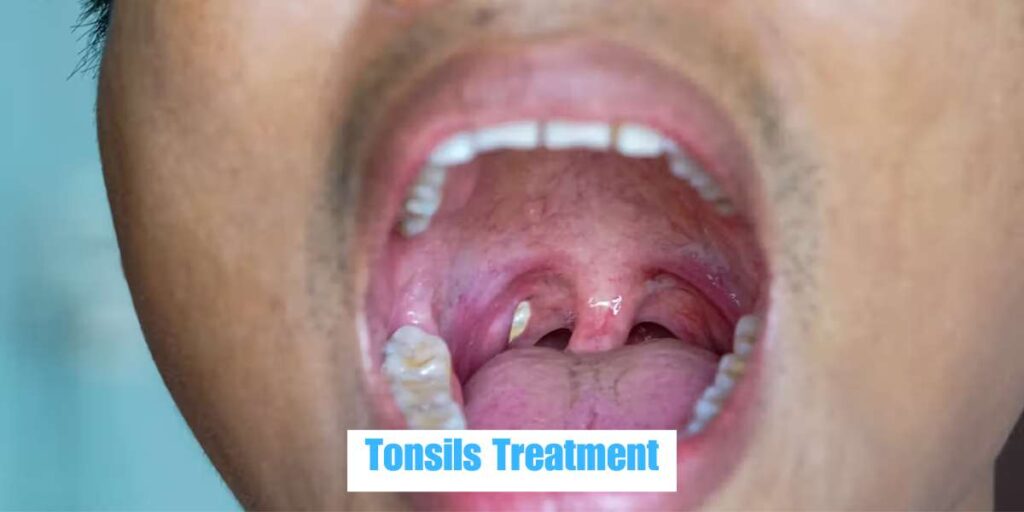 Tonsils treatment in bhubaneswar