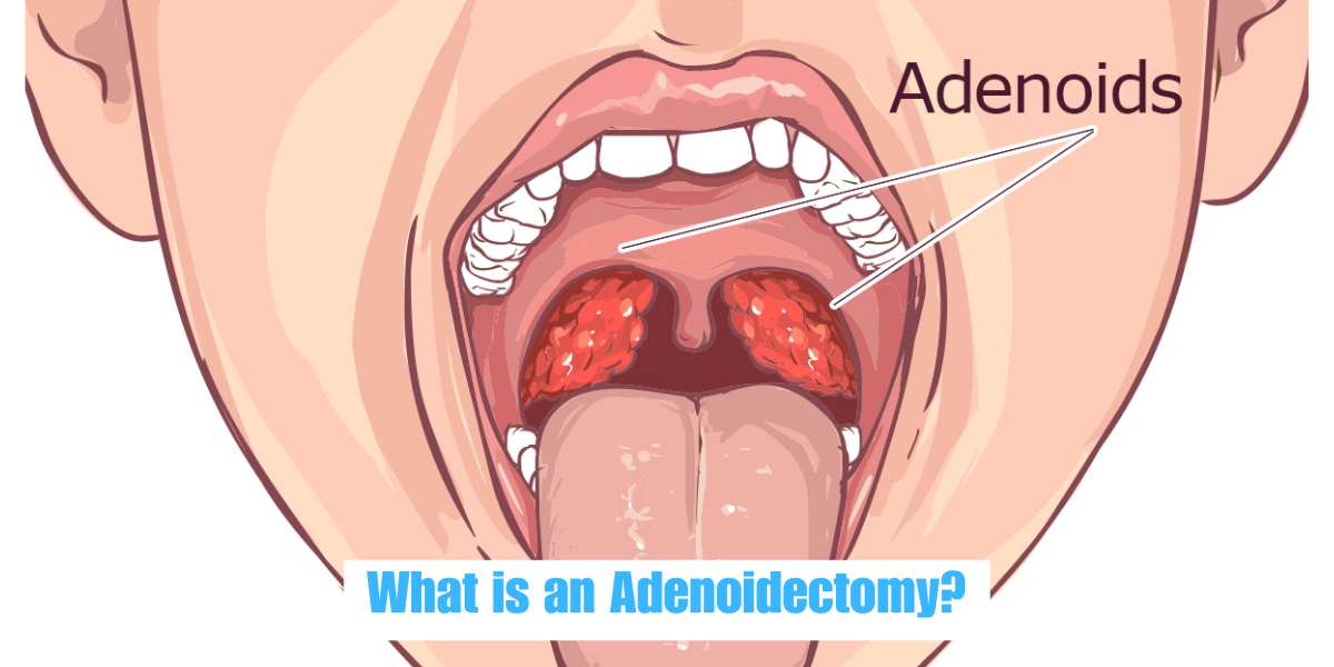 What is Adenoid Hypertrophy?