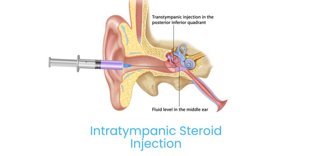 Intratympanic Steroid Injection in Bhubaneswar