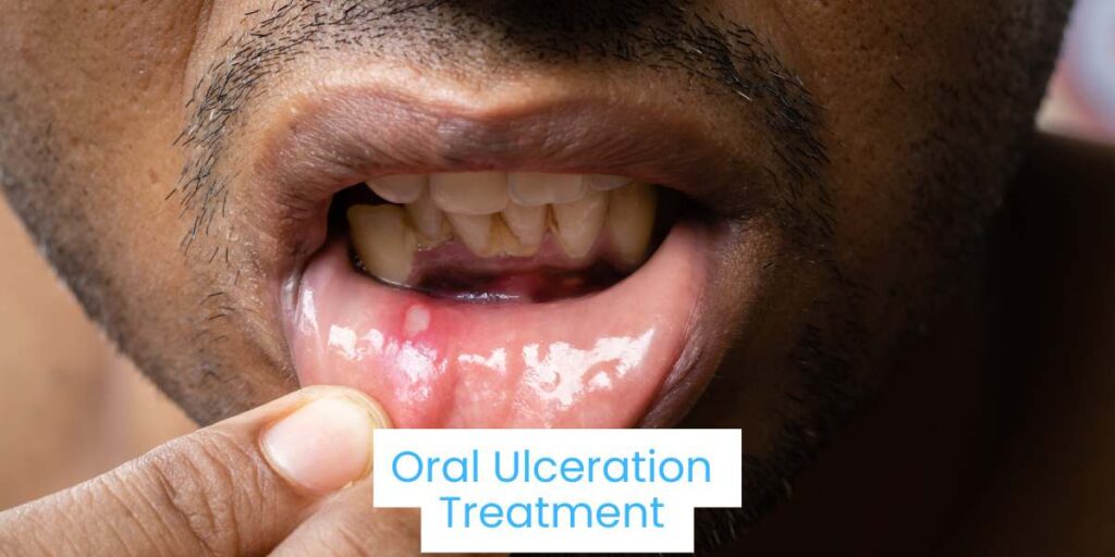 Oral Ulceration Treatment in Bhubaneswar