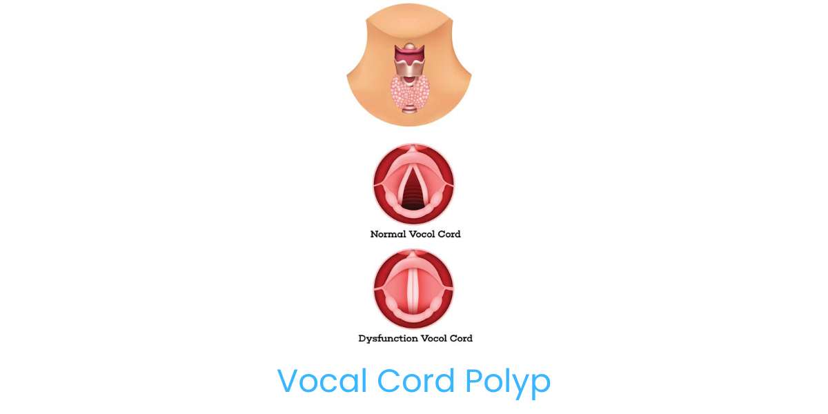 Vocal Cord Polyp: Understanding Causes, Symptoms, and Treatment in Bhubaneswar