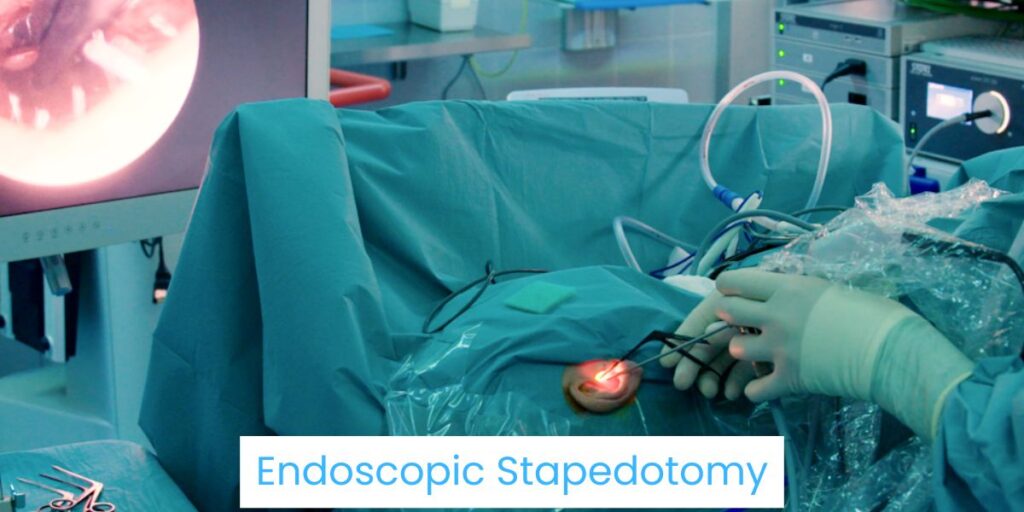 Endoscopic Stapedotomy in bhubaneswar