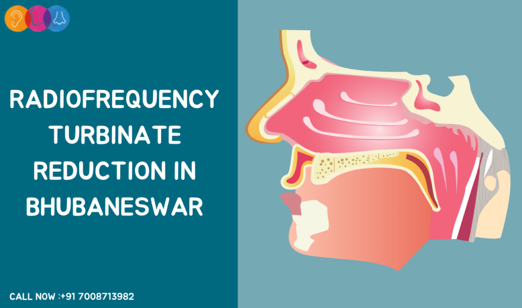 Radiofrequency Turbinate Reduction in Bhubaneswar