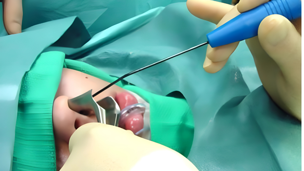 adenoidectomy surgery in Bhubaneswar