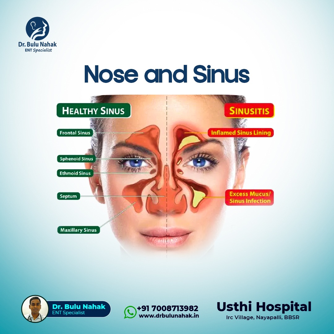 Nose and Sinus Health: Understanding Sinusitis, Causes, Symptoms & Treatment